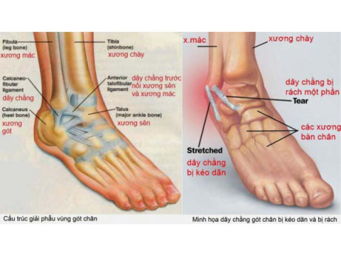 Nguy hiểm nếu bạn không biết cách xử lý chấn thương Lật sơ mi cổ chân.