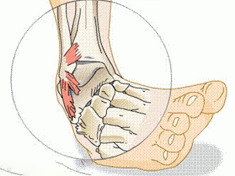 Chấn thương cổ chân- Chấn thương lật sơ mi cổ chân